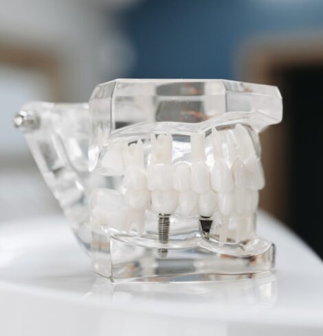 How to maintain the quality of your dental implants?